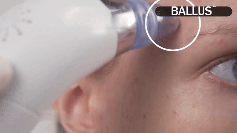 π§Ό Deep Clean Pore Vacuum β¨ USB Rechargeable | Blackhead Remover Tool πββ